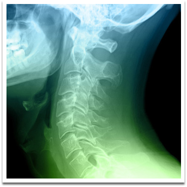 x-ray of neck